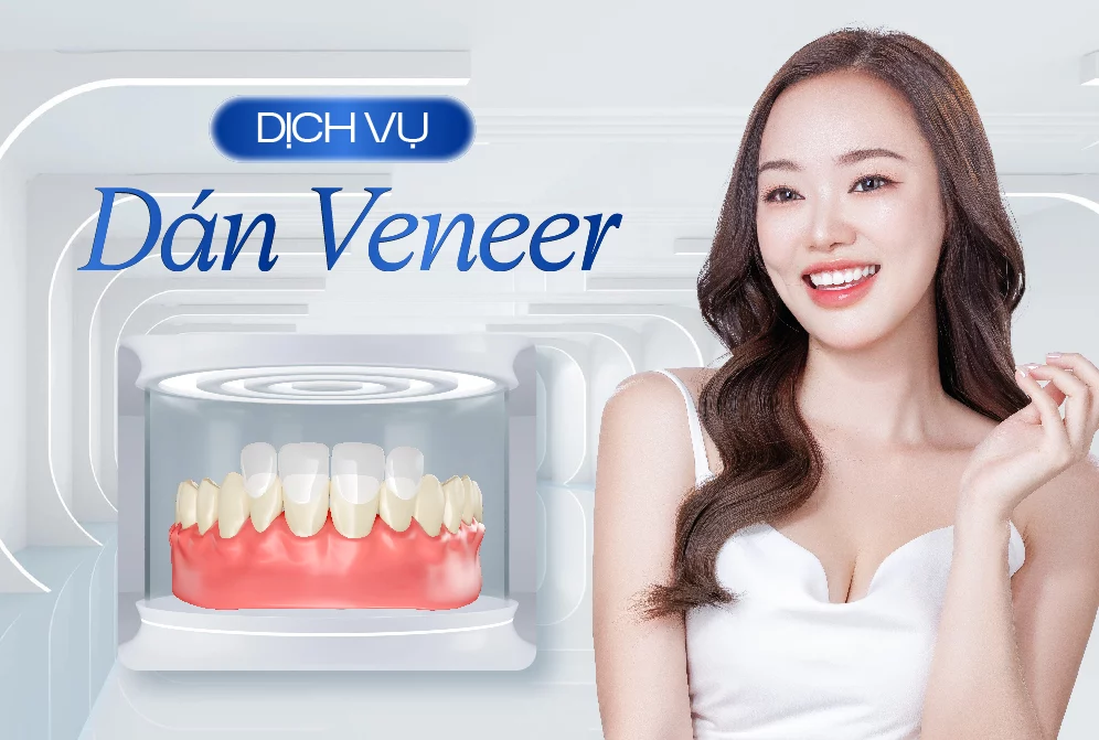 Dán Veneer