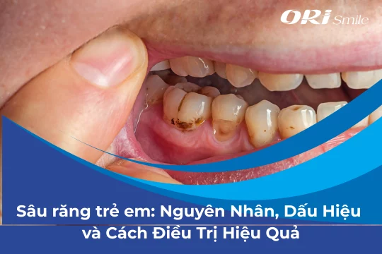 Sâu răng trẻ em: Nguyên Nhân, Dấu Hiệu và Cách Điều Trị Hiệu Quả