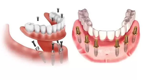 Phục hình trên Implant – Giải pháp tối ưu cho người bị mất răng lâu năm