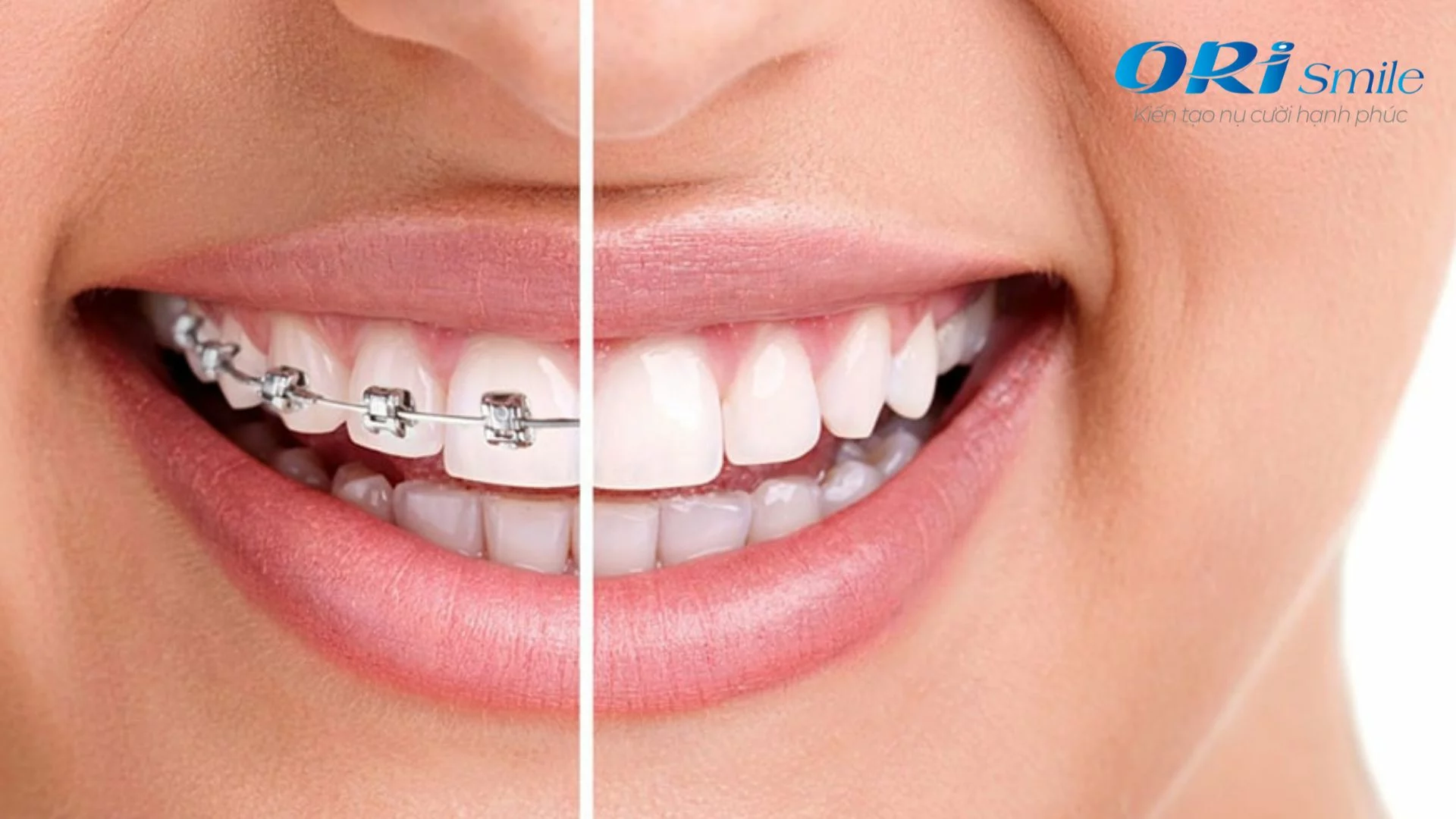 Hình ảnh trụ Implant Straumann và răng sứ