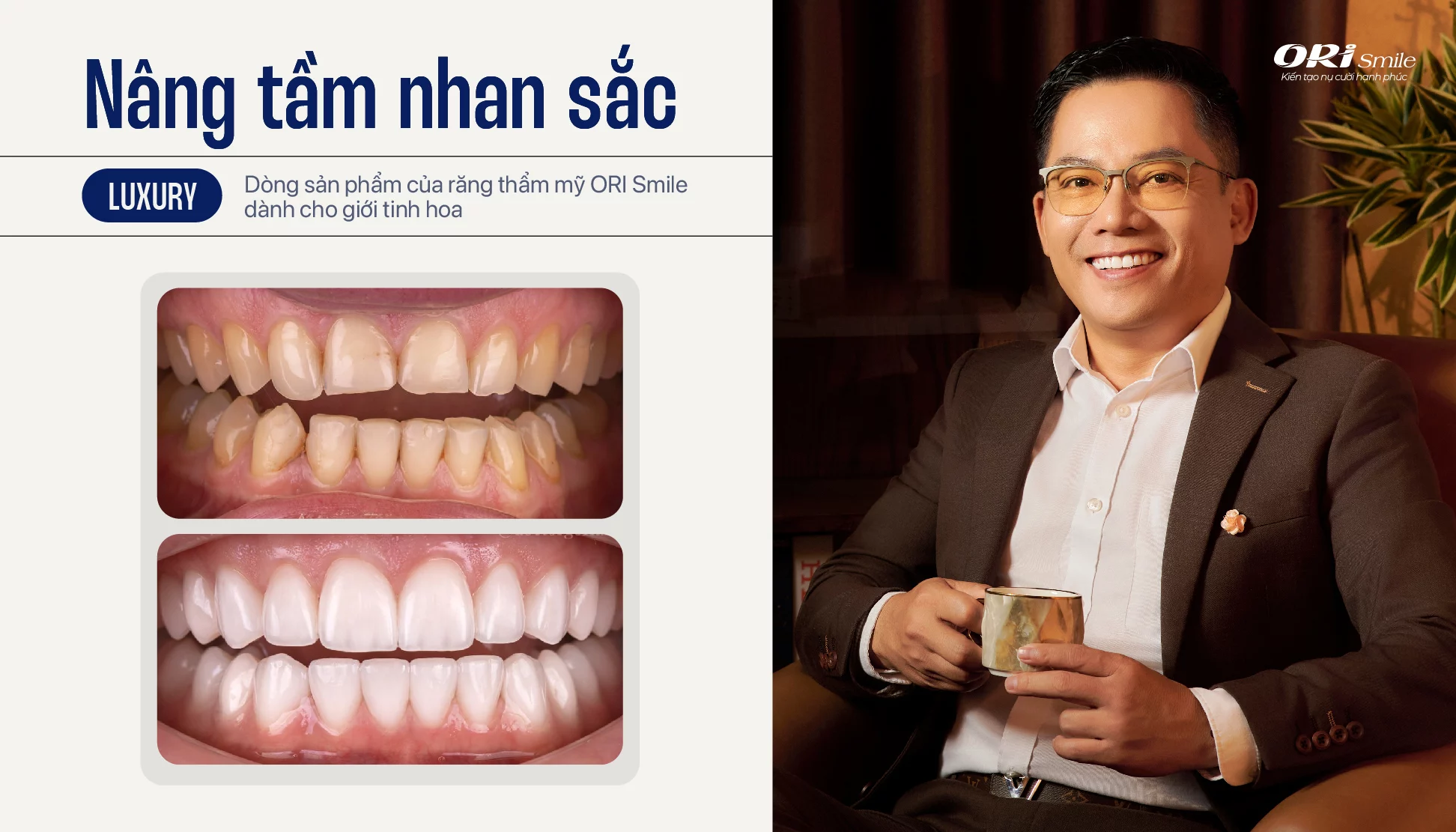 Hình ảnh trụ Implant Straumann và răng sứ