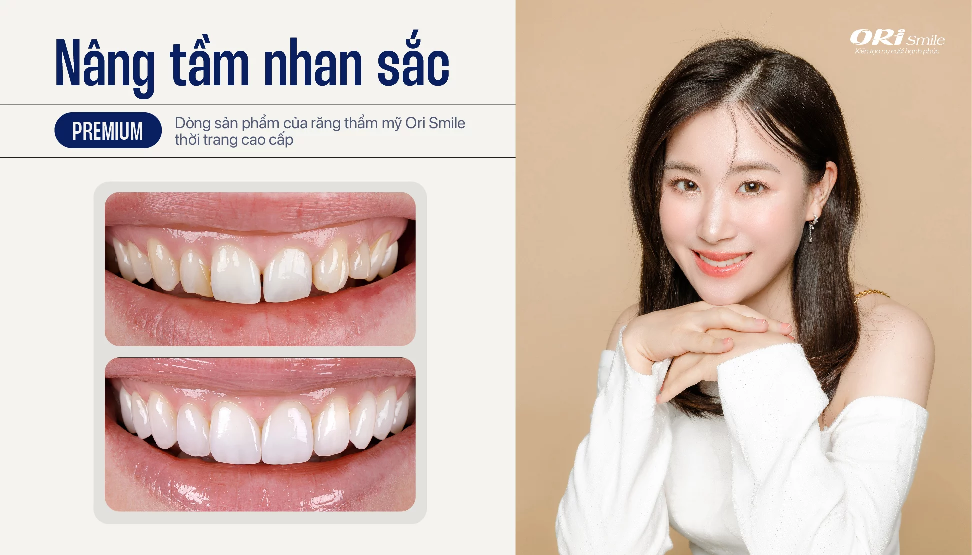 Hình ảnh trụ Implant Straumann và răng sứ