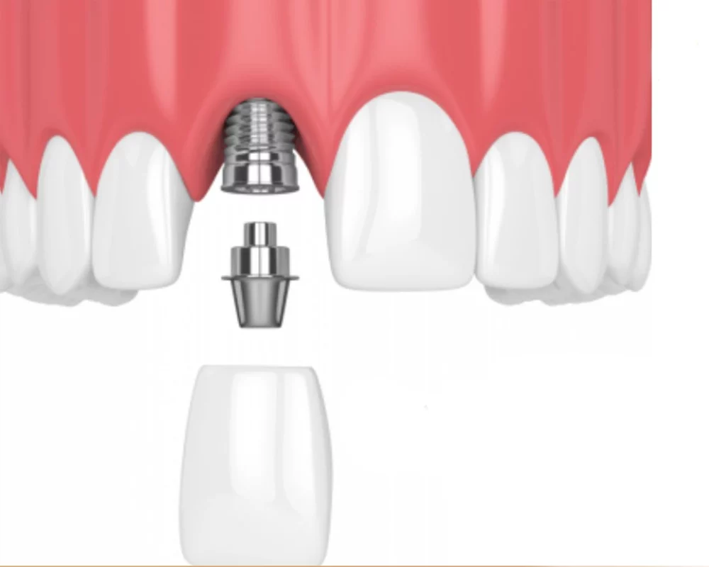 Hình ảnh trụ Implant Straumann và răng sứ